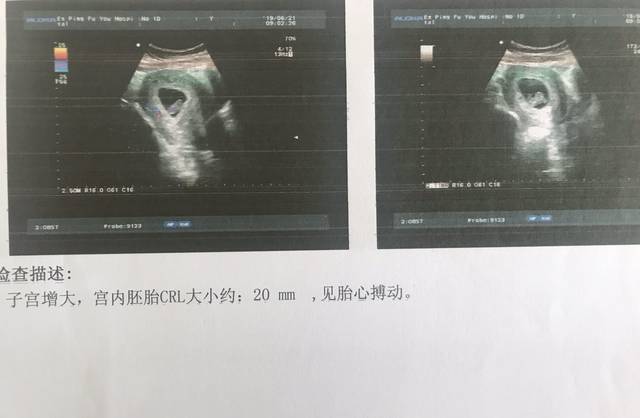 取卵的费用大概是多少
