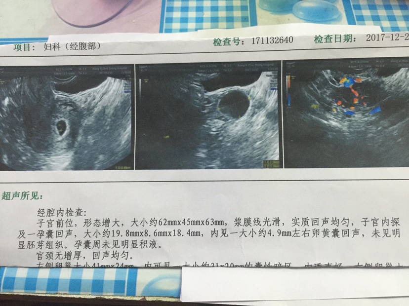 供卵试管婴儿怎么做龙凤胎
